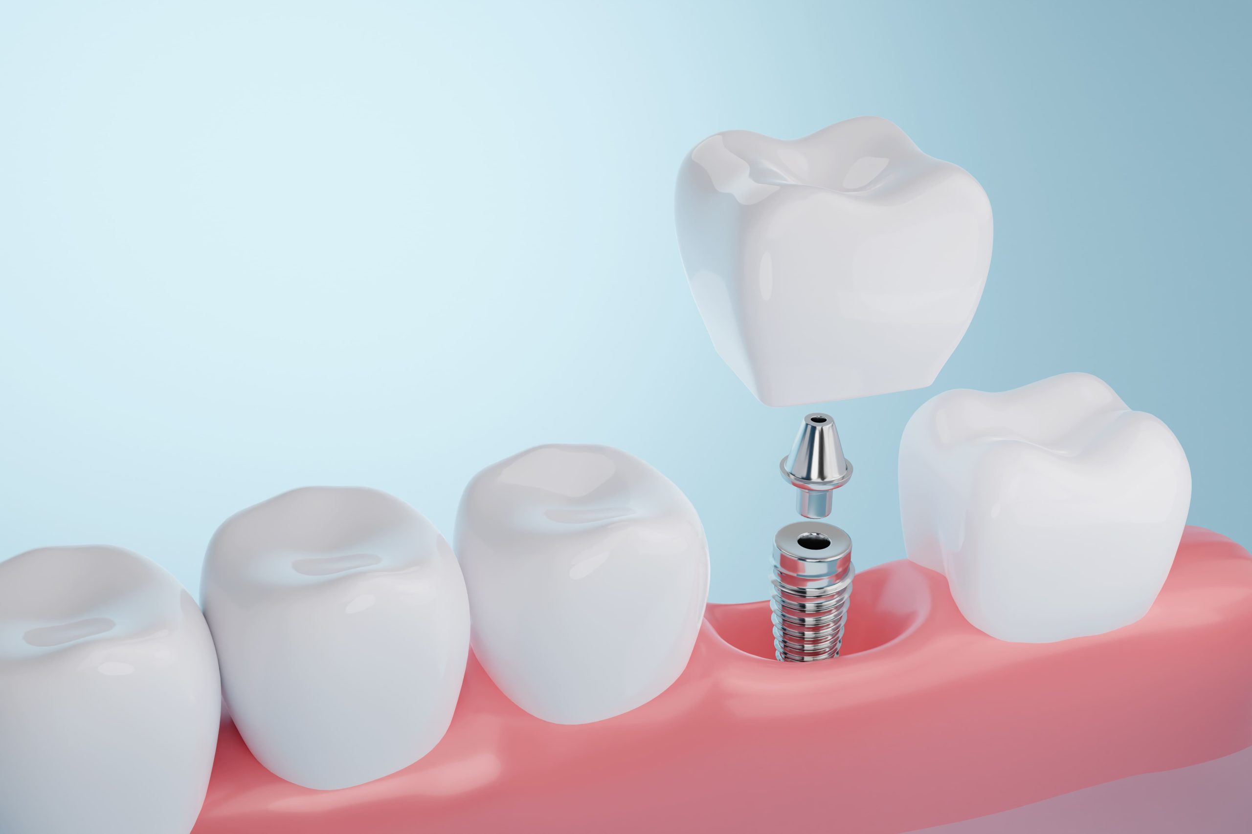 Implantes dentários: Como recuperar a mastigação?